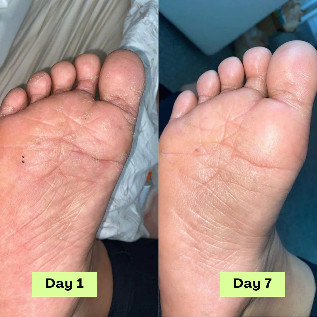 YOSIS® Antifungal Relief Soap Bar