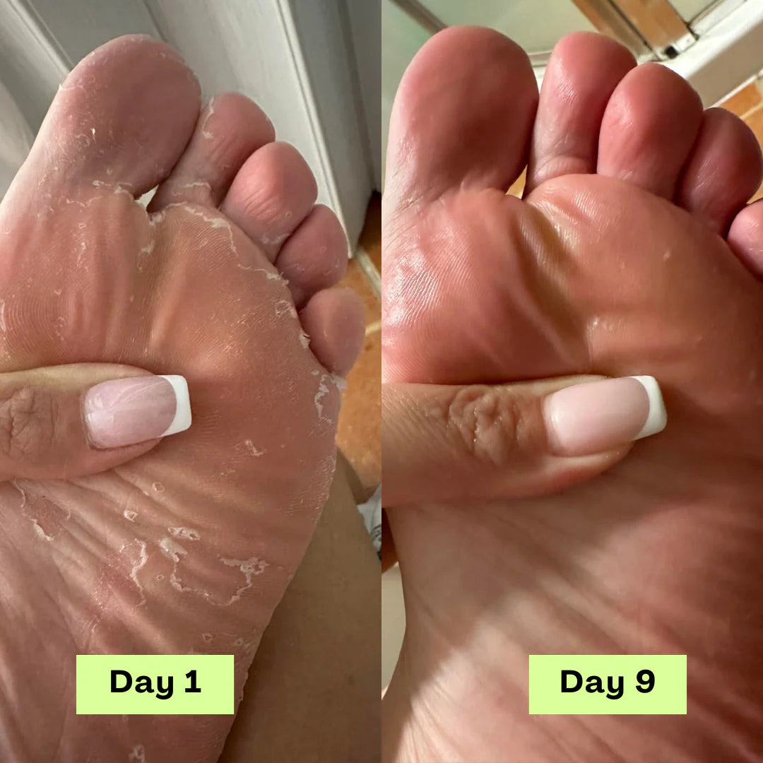 YOSIS® Antifungal Relief Soap Bar