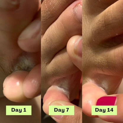 YOSIS® Antifungal Relief Soap Bar