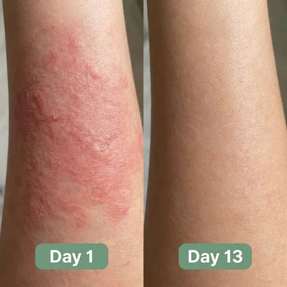 YOSIS® Antifungal Relief Soap Bar