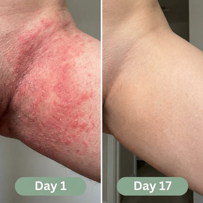 YOSIS® Antifungal Relief Soap Bar